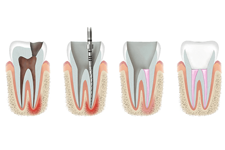 Сколы зубов в результате травмы